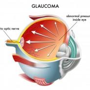 Understand Glaucoma