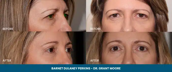 Before-and-after collage of a woman's face showing cosmetic improvements around the eyes and forehead.