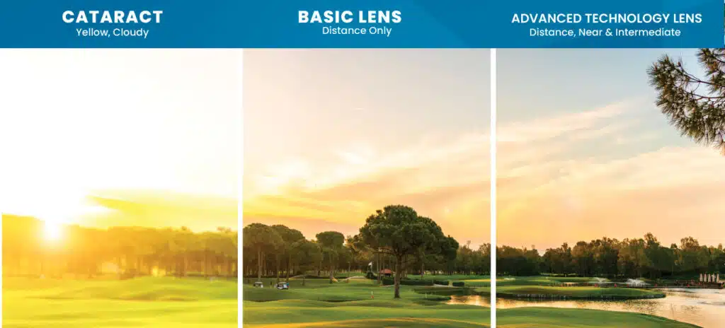 Infographic illustrating the difference between a view with cataracts, with a basic lens, and with advanced technology lens