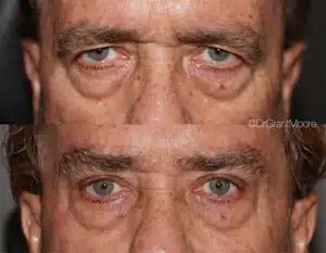 Two close-up shots of an elderly man's eyes, with deep wrinkles and a tired expression.