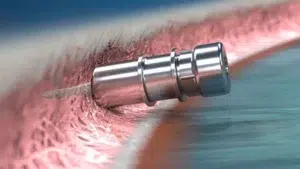 iDose Glaucoma implant used at Barnet Dulaney Perkins.