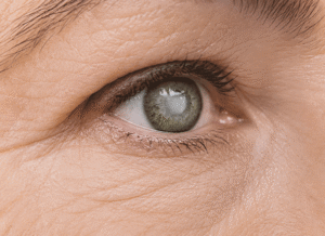 Phot of a female senior with a cataract in her green eye; What are Cataracts with Barnet Dulaney Perkins.