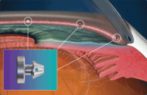 Medical illustration showing iDose® TR and MIGS positioned near the eye’s natural drainage pathway