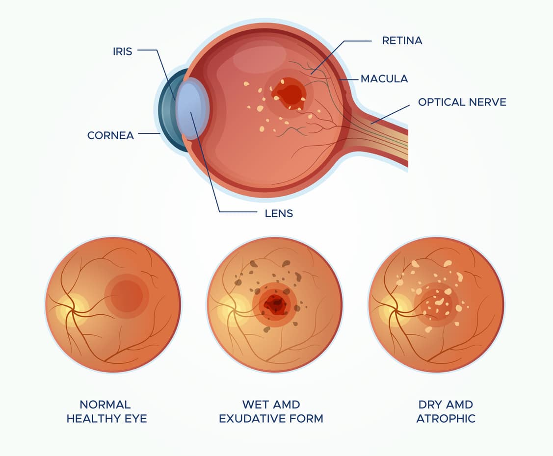 Macular Degeneration Treatment in Arizona | Retina Specialists