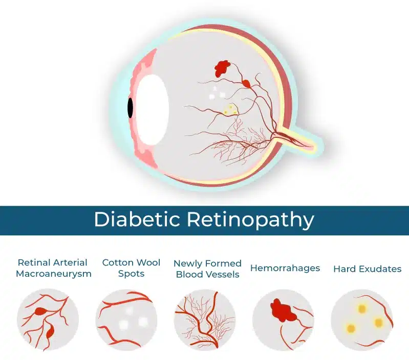 BDP Diabetic Retinopathy