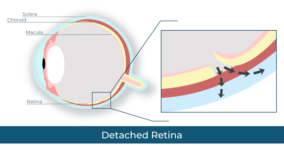 Retinal Detachment diagram