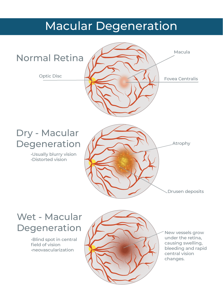 Macular Degeneration types graphic