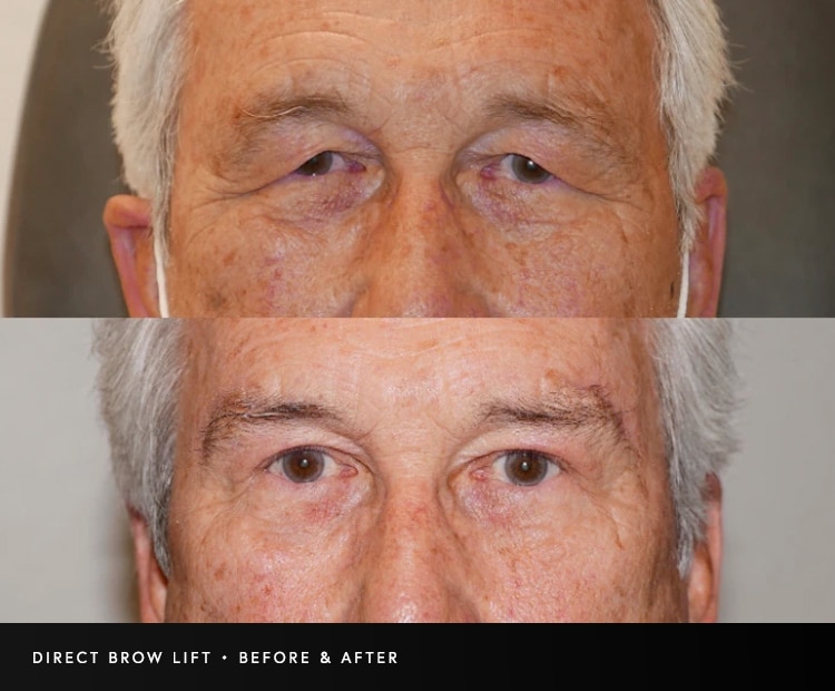 Male direct brow lift surgery before and after