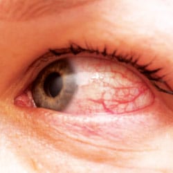 Does Eye Laser Surgery Cause Dry Eye