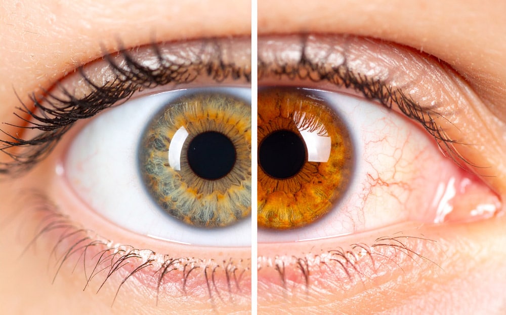 On one side, a healthy eye with clear white sclera and bright iris. On the other, an eye affected by smoking — red and irritated, with visible blood vessels, yellowing in the sclera, and subtle signs of cataracts or vision clouding.