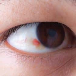 Healthy-Eye-vs-Diseased-Eye
