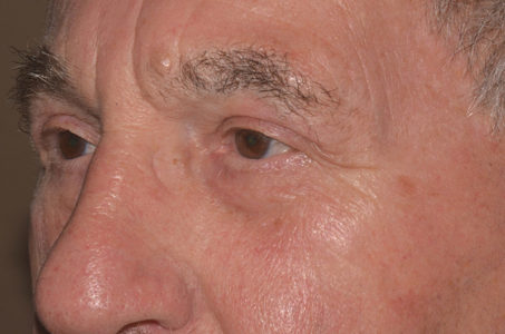 AFTER - After Dr. Berbos performed an upper eyelid blepharoplasty, the patient noticed improved peripheral vision, increased brightness in his vision, and resolution of the “heavy and tired” feeling he had before surgery.
