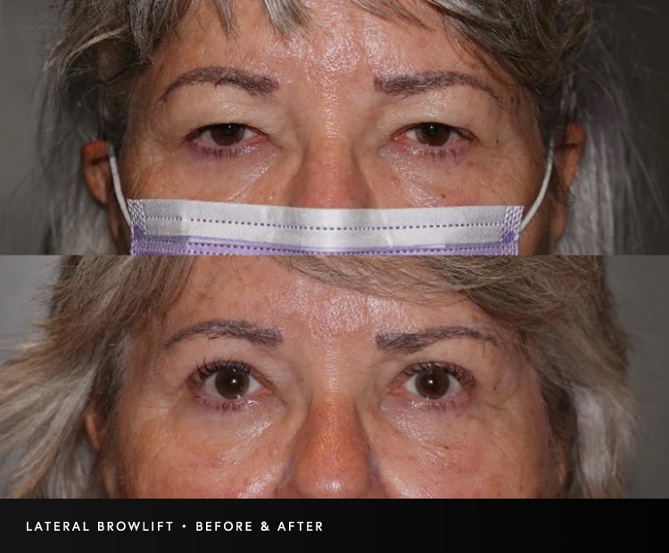 Lateral Browlift Before and After