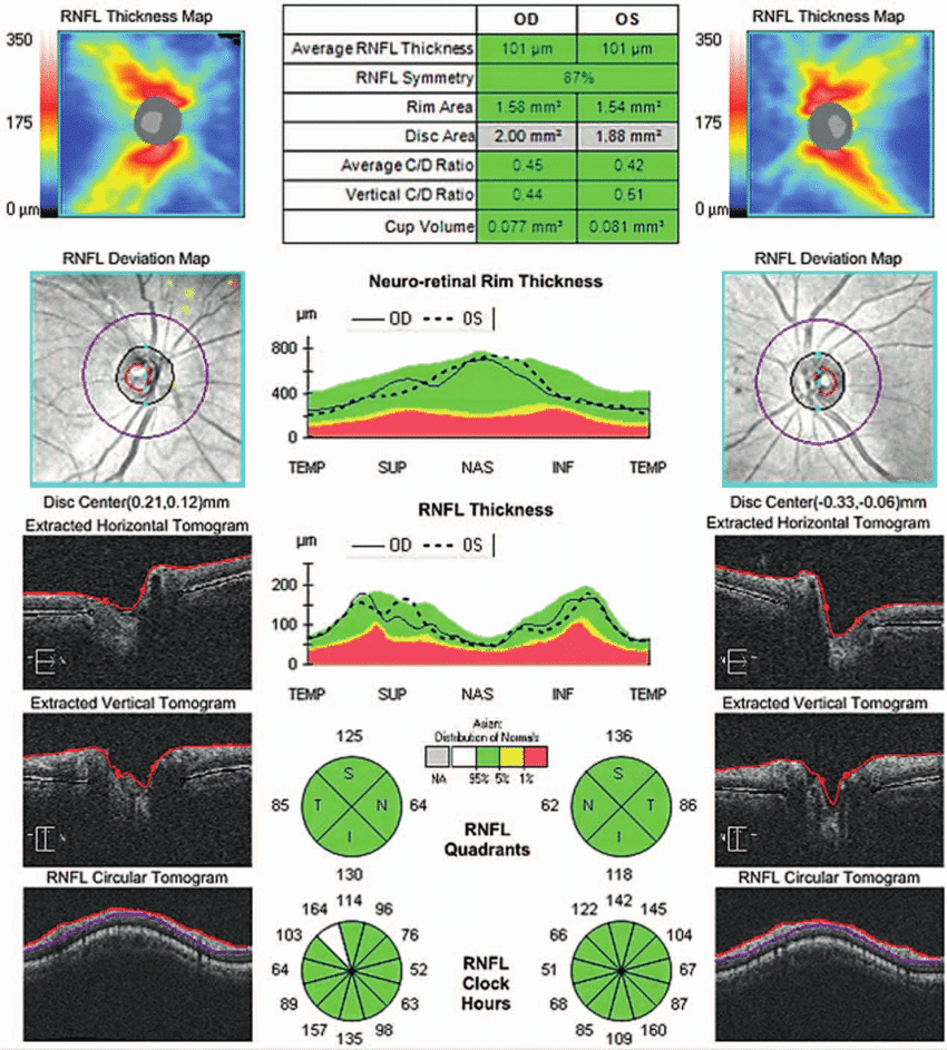 Optic nerve head (ONH) and retinal nerve fiber layer (RNFL) analysis
