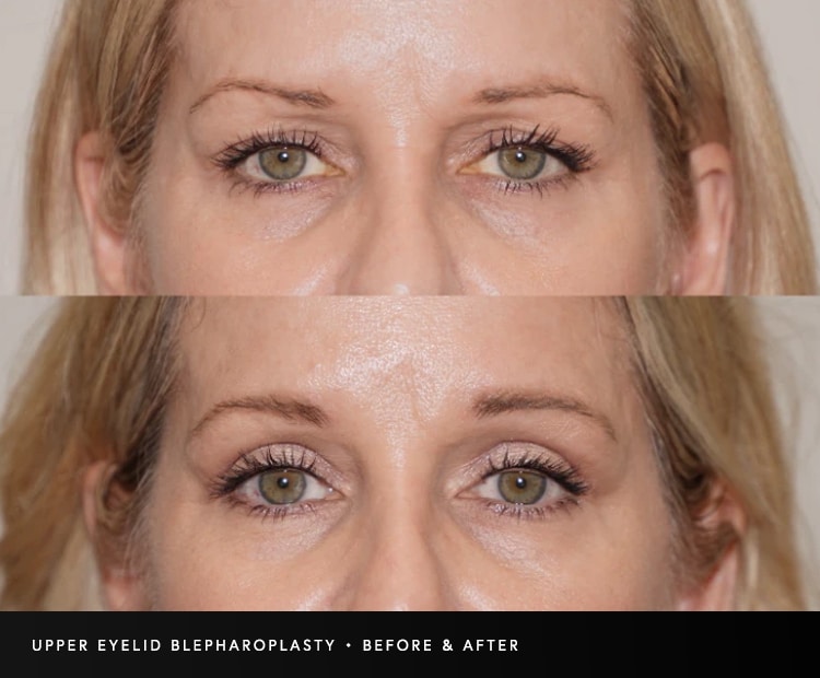 how to tell double eyelid surgery