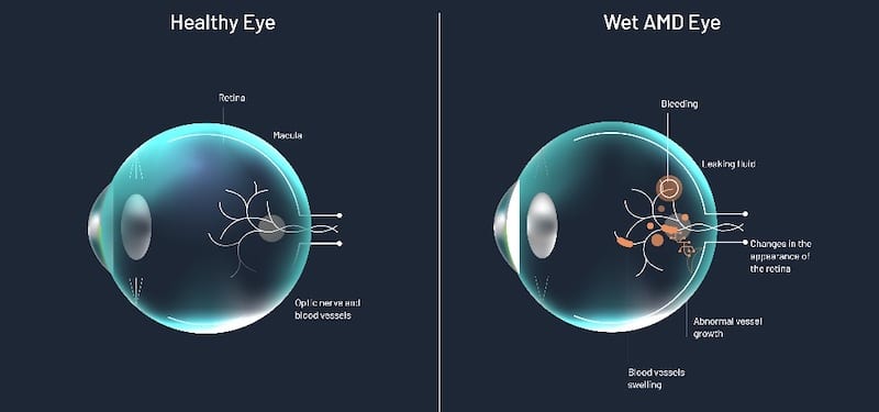 diagram showing the healthy eye versus an eye with wet AMD