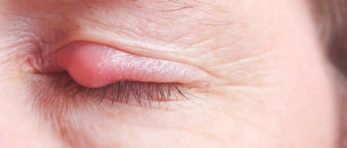 closed eye with sty, eyelid soreness may be caused by sty