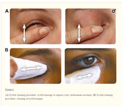 eyelid cleaning procedure