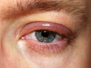 Persistent eyelid inflamation can be an early sign of eyelid cancer, find treatment at Barnet Dulaney Perkins, in Phoenix, Arizona.