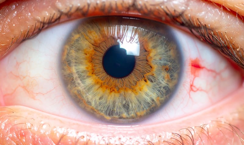 An up-close, high-resolution clinical photograph of a human eye showing visible signs of advanced glaucoma.