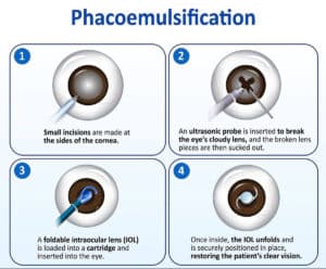 how to prepare for cataract surgery through the phacoemulsification procedure at barnet dulaney Perkins