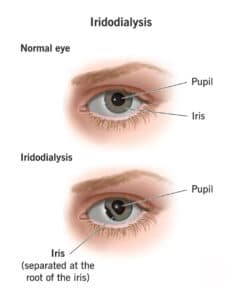 iridodialysis diagram provided by Barnet Dulaney Perkins