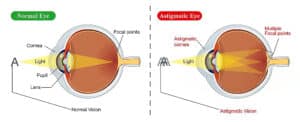 side-by-side diagram of normal versus astigmatic eye showing multiple focal points and causes of blurry vision