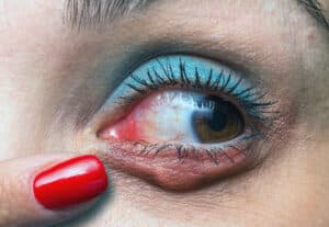 Finger indicating a red chalazion near the eye to show possible floaters cause
