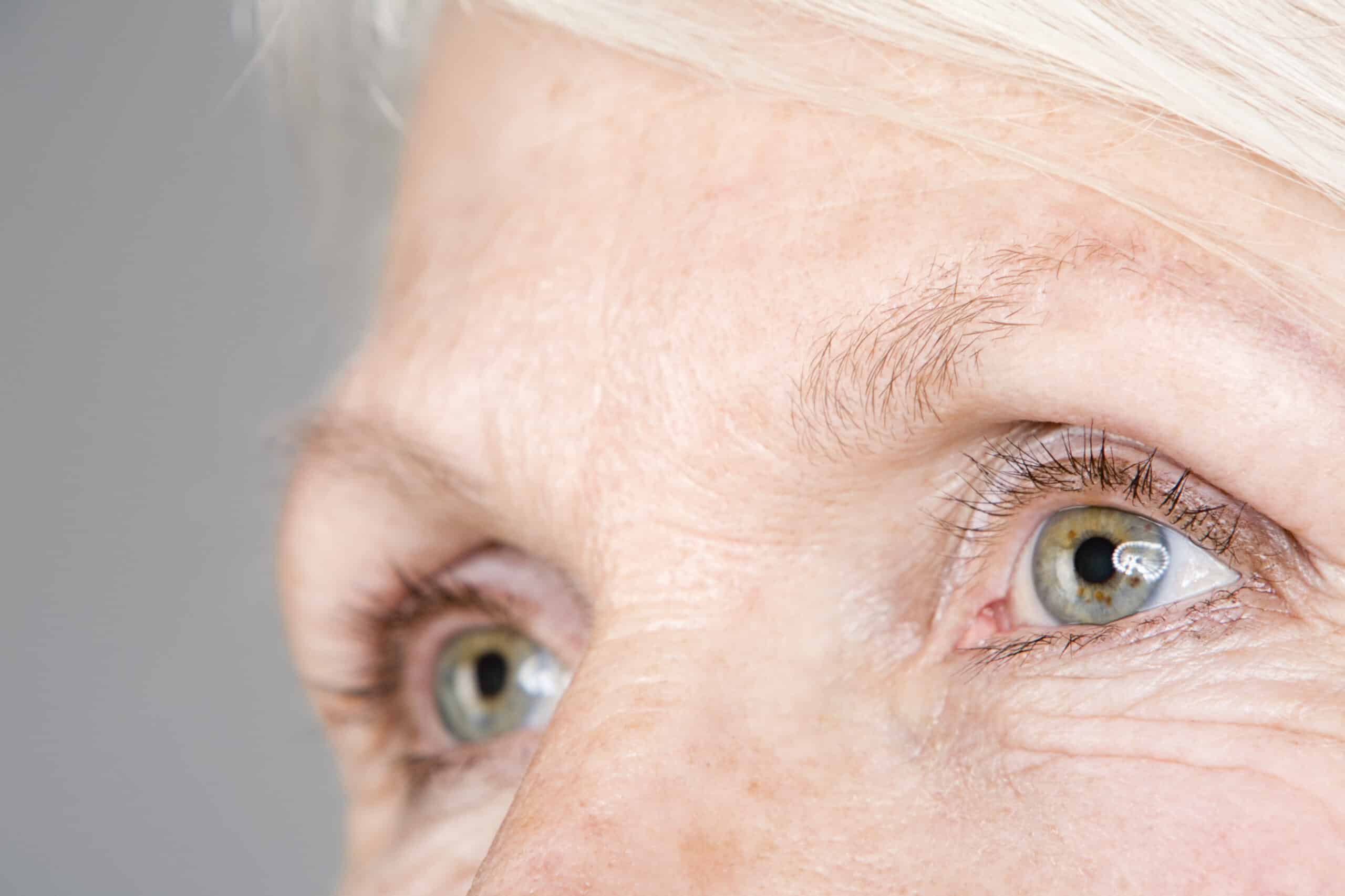 Does eye color affect early signs of cataracts?
