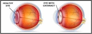 diagram comparing a healthy lens to a lens with cataracts, showing clouding associated with early signs of cataracts - Barnet Dulaney Perkins