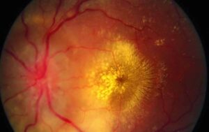 Hypertensive Retinopathy in the eye from Barnet Dulaney Perkins.