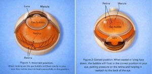 Diagram showing corect bubble placment in the eye for safe retinal surgery recovery at Barnet Dulaney Perkins in Phoenix, Arizona.