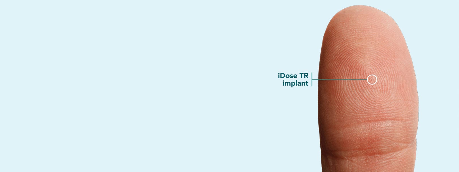 Close-up of a fingertip showing the small size of the iDose TR implant.