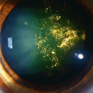 Christmas tree cataract can be treated at Barnet Dulaney Perkins.