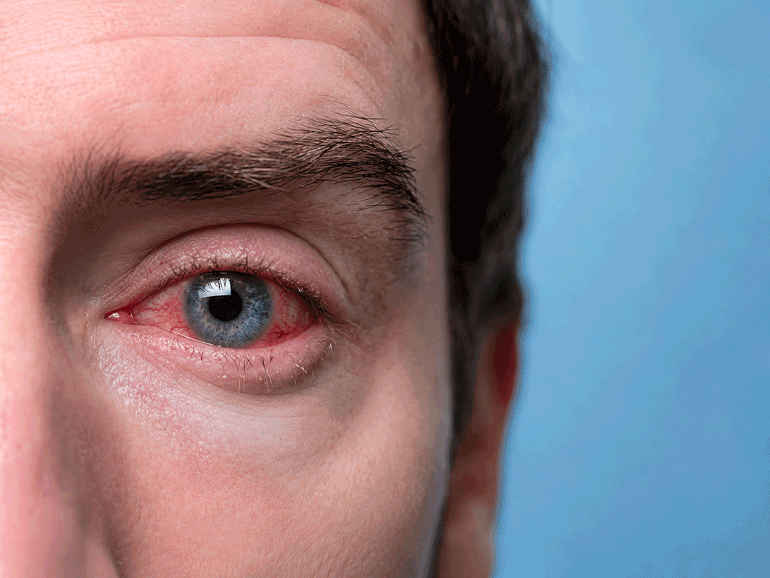 Close-up of a man’s red, irritated eye showing visible pink eye symptoms for Barnet Dulaney Perkins Eye Center.