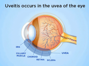 Medical eye anatomy diagram labeling the iris, ciliary muscle, choroid, retina, sclera, and uvea to explain uveitis treatment at Barnet Dulaney Perkins Eye Center.