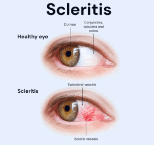 Healthy eye and scleritis comparison showing inflamed scleral and episcleral blood vessels, explaining what scleritis is for Barnet Dulaney Perkins Eye Center.