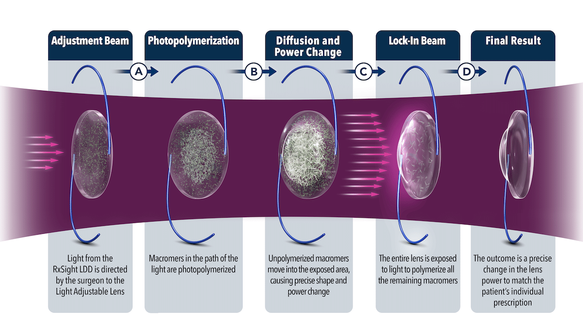 Graphic showing advanced light-adjustable lens process and how it impacts cataract surgery cost in Arizona
