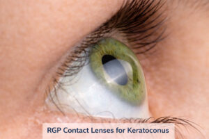 Extreme close-up of a green eye wearing an RGP specialty contact lens for keratoconus at Barnet Dulaney Perkins Eye Center