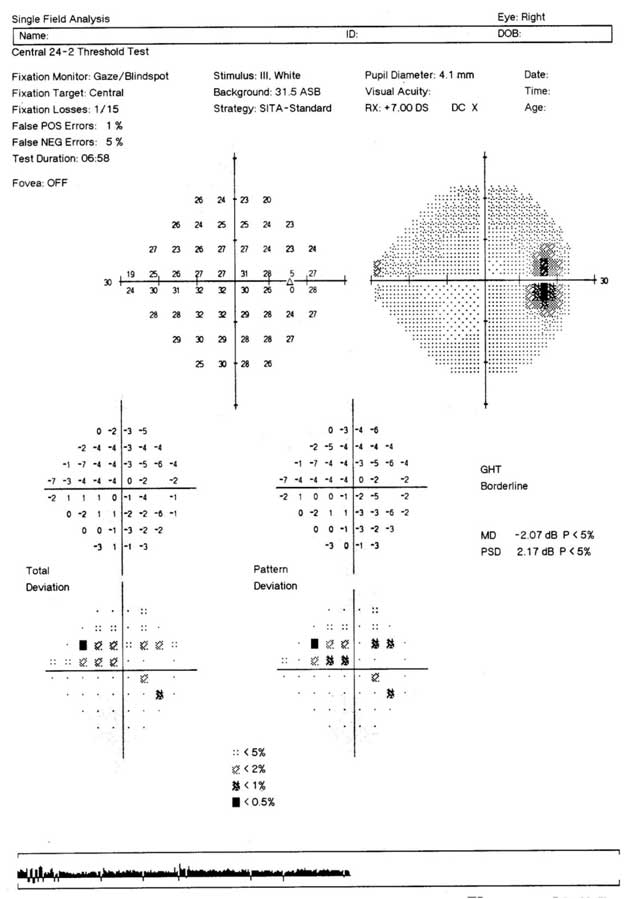 visual field test, eye test