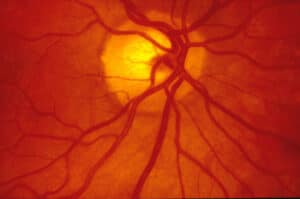 Close-up of the human retina illustrating causes of why you keep seeing spots